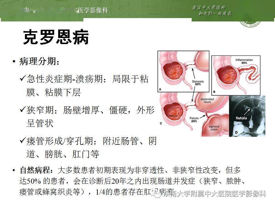 最新克罗恩病治疗方法概述